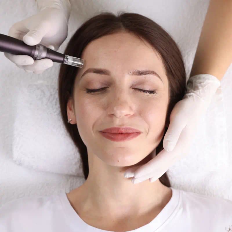 Microneedling Behandlung — straffere Haut durch Kollagenaktivierung im GK Cosmetic Studio Schönbühl